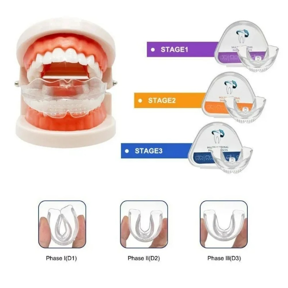 Teeth Whitening For Braces - Aparelho Ortodôntico Alinhador de Dentes para