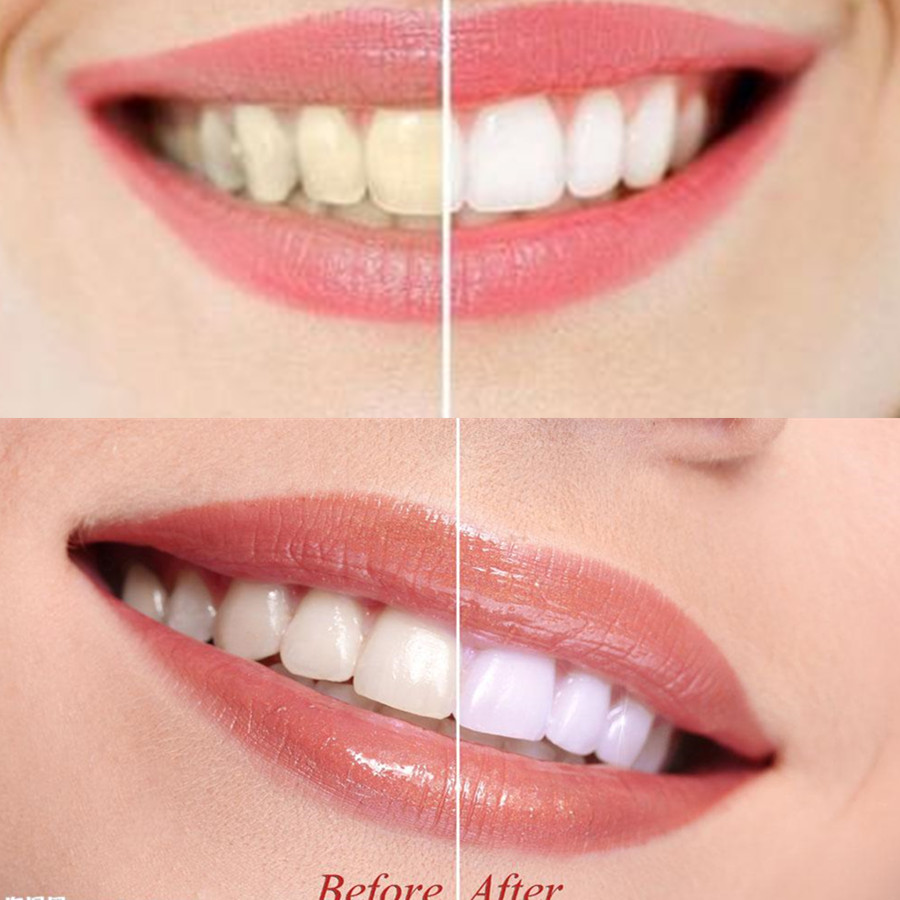 Dentes de carvão vegetal de ba - Teeth Whitening Results avaliação e preço
