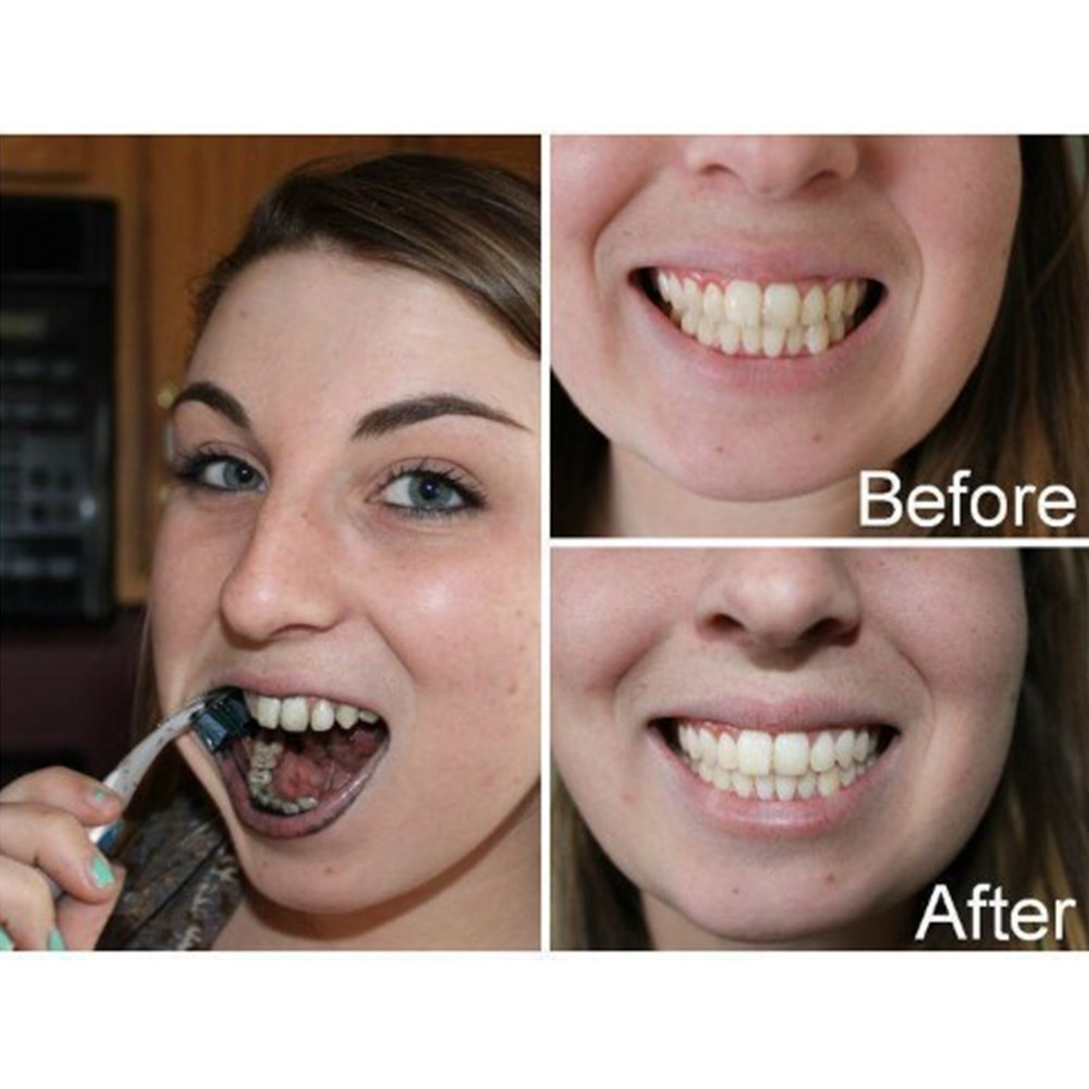 Dentes de carvão vegetal de ba - Teeth Whitening Results avaliação e preço