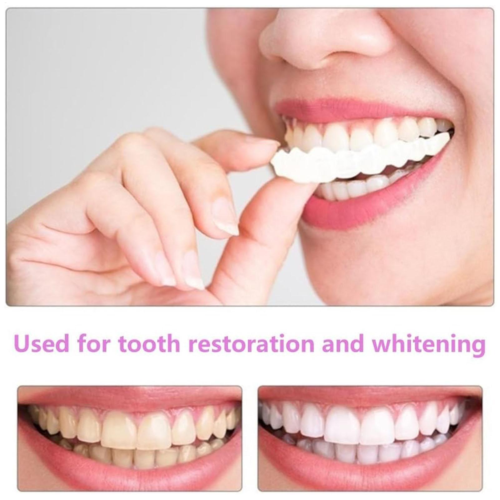 Capa Dentária Superior e Infer - Teeth Whitening For Braces avaliação e preço