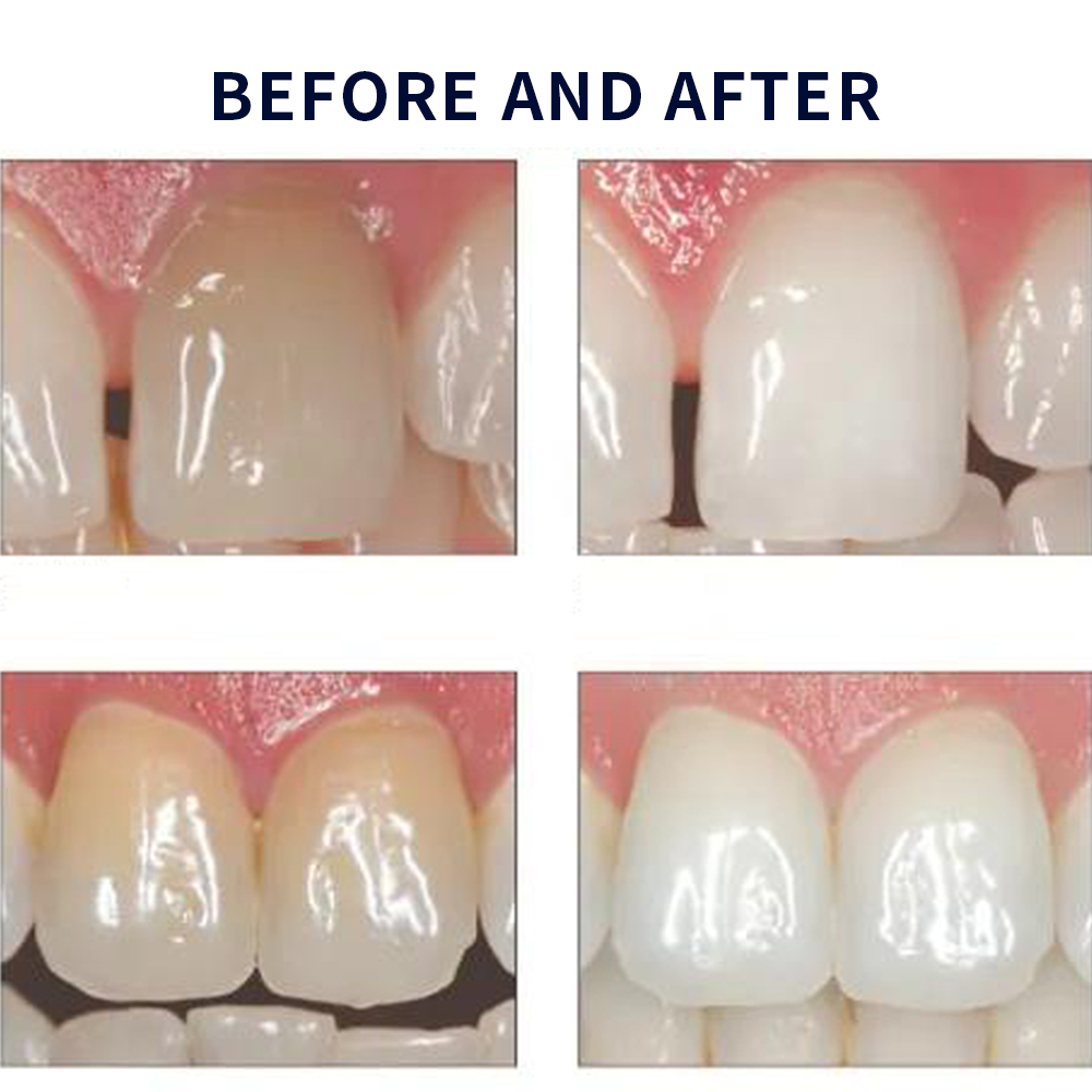 Opalescência Whitening Gel Kit - Teeth Whitening In Office avaliação e preço