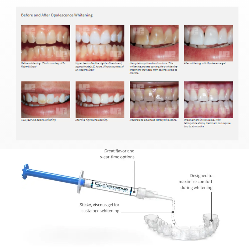 Opalescência Whitening Gel Kit - Teeth Whitening In Office avaliação e preço