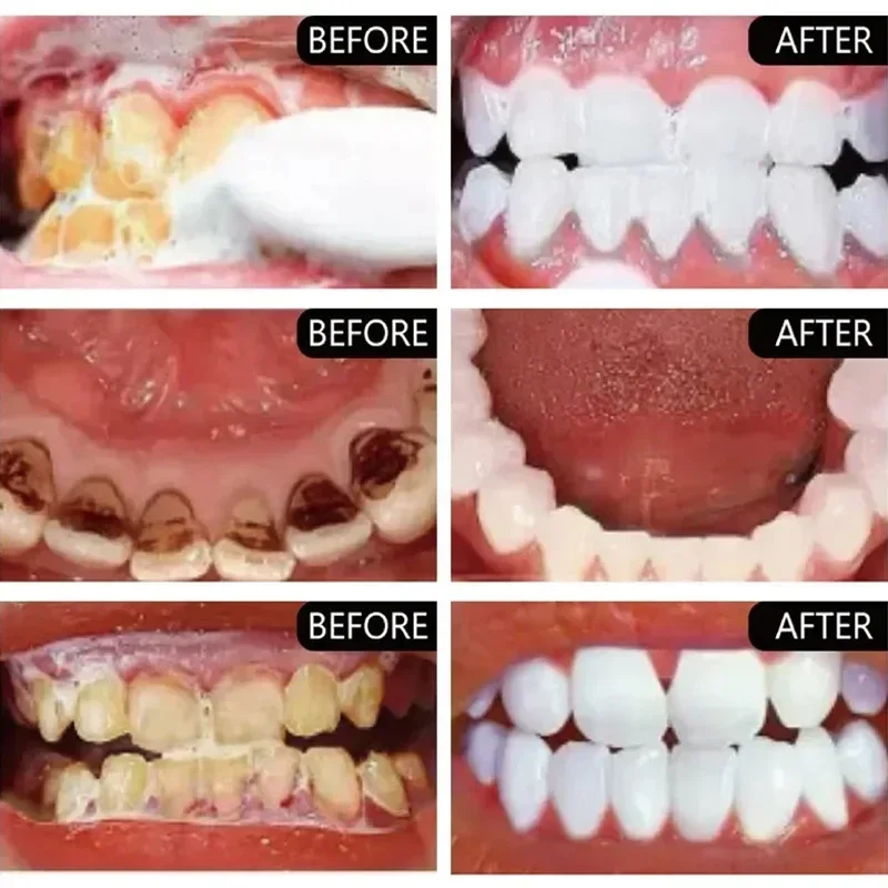 Remoção rápida de manchas de f - Teeth Whitening Fast avaliação e preço