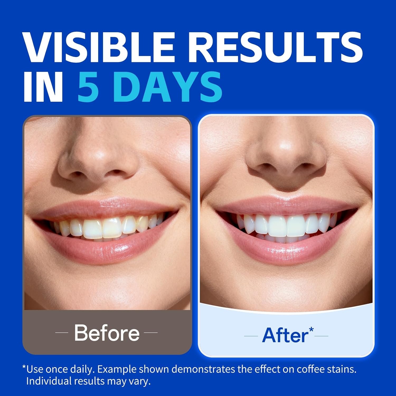 1/7 pares de tiras de clareame - Teeth Whitening Street avaliação e preço