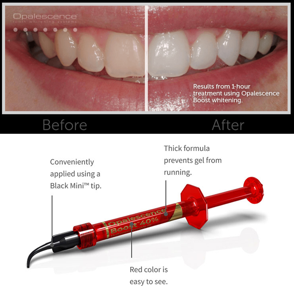 Gel Clareador Dental Ultradent - Teeth Whitening Gel Opalescence avaliação e preço